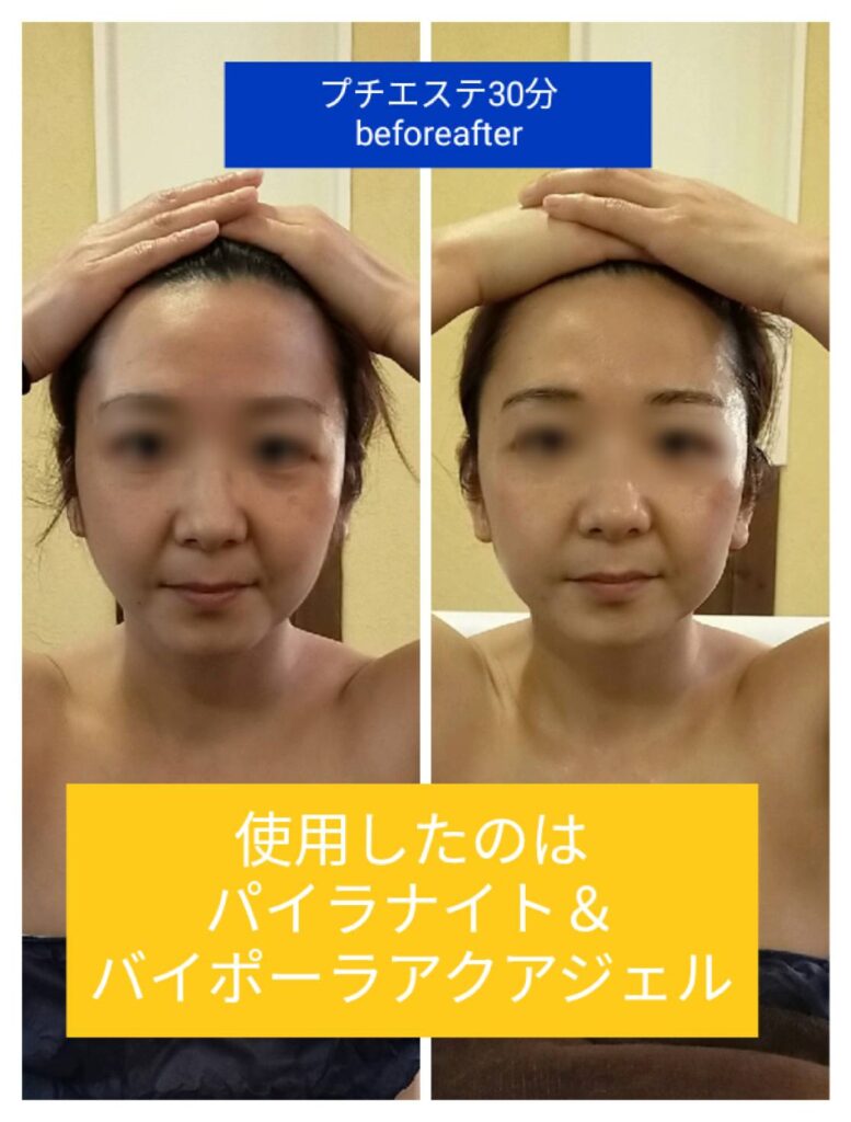 パイラナイト （画像有り】パイラナイトで痩せるのは可能？50人に施術 