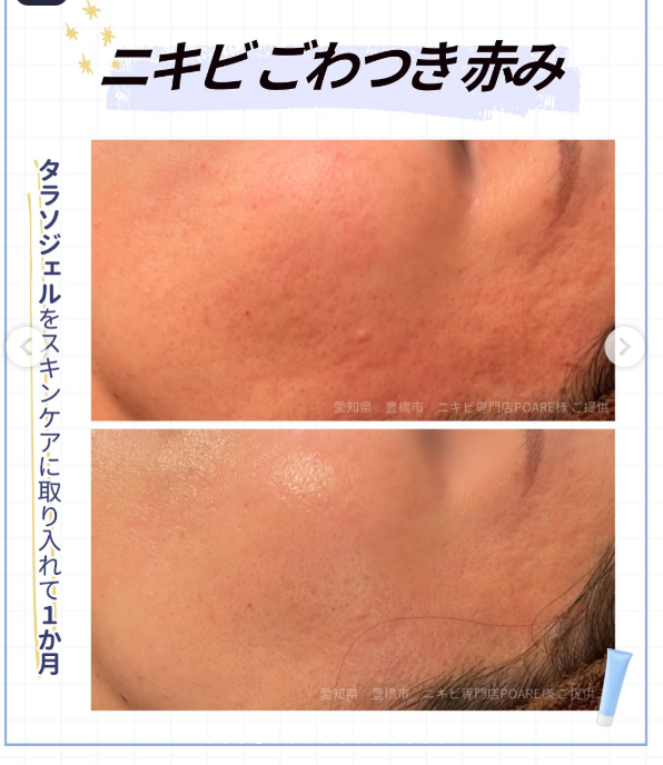 削らず、急がず、肌を育てる。 敏感肌のためのフィトレチノール習慣セット - 画像 (12)